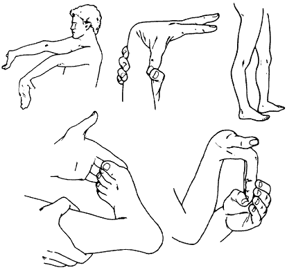 Figure 1 - Loose unstable joints