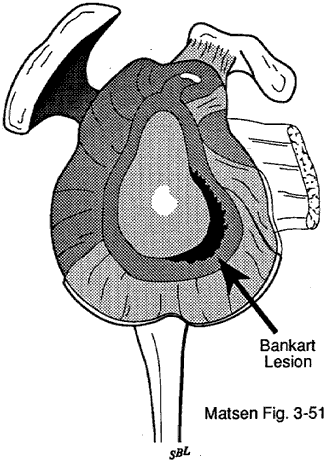 Figure 2 - Bankart lesion