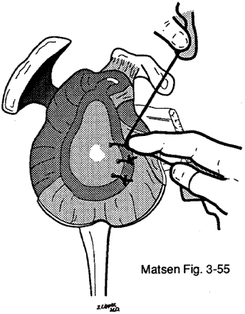 Figure 3 - The knots are tied so that they come to rest over the capsule