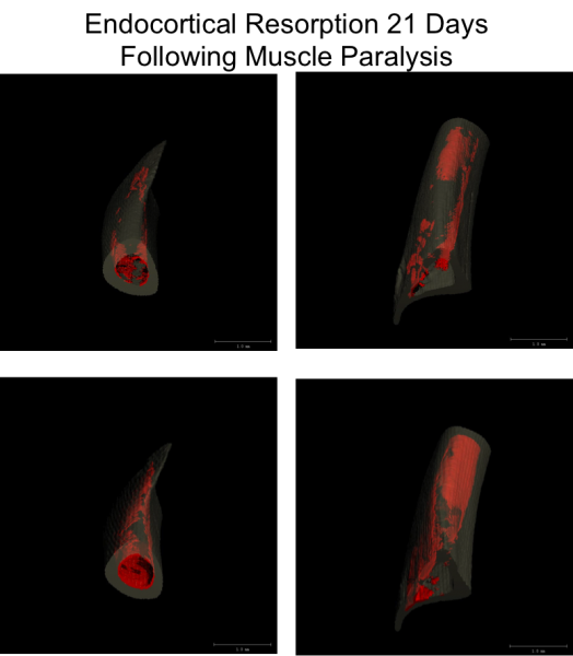 Focal osteoclastic resorption following muscle paralysis Endocortical Expansion in the tibia of mice following transient muscle paralysis
