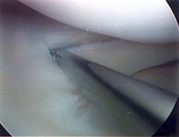 Arthroscopic Meniscus Repair