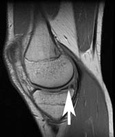 Arthroscopic Meniscus Repair