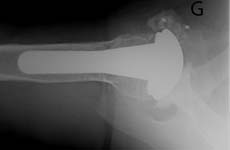 Reverse Total Shoulder Reverse Total Shoulder