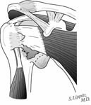 Reverse Total Shoulder Reverse Total Shoulder