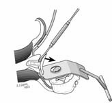 Reverse Total Shoulder Reverse Total Shoulder