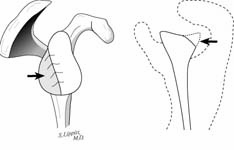 Reverse Total Shoulder Reverse Total Shoulder