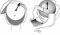 Reverse Total Shoulder Reverse Total Shoulder