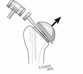 Reverse Total Shoulder Reverse Total Shoulder