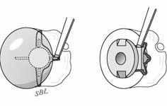Reverse Total Shoulder Reverse Total Shoulder