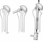 Reverse Total Shoulder Reverse Total Shoulder