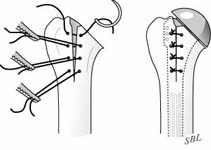 Reverse Total Shoulder Reverse Total Shoulder