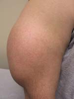 Soft Tissue Masses. a benign soft tissue mass in the arm.