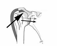 Reverse Total Shoulder