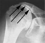 Reverse Total Shoulder