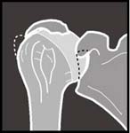 Reverse Total Shoulder