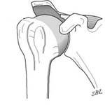 Reverse Total Shoulder