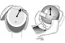 Reverse Total Shoulder