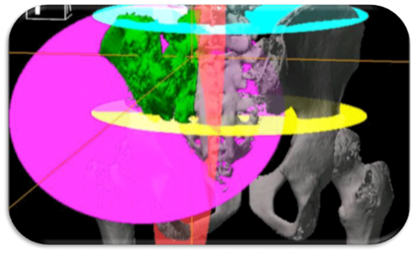 Surgical Navigation in Orthopaedic Oncology: Promise or Peril? photo
